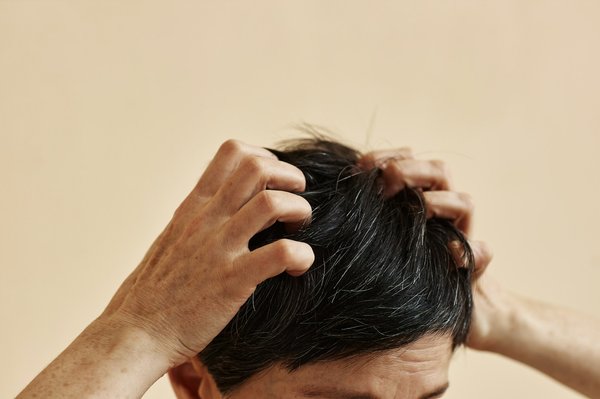 Eczéma cuir chevelu : trouvez les solutions qui apaisent